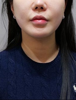 在JRYN釜山皮肤科做钛提升+韩版超声提拉后，脸真的紧了！术前术后变化太绝