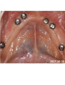 韩国NewYorkWhite牙科种植牙前后对比：医生种牙技术好骨量不足也能解决！