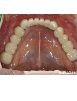 韩国NewYorkWhite牙科种植牙前后对比：医生种牙技术好骨量不足也能解决！