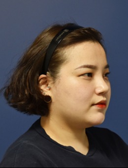 弘大凯特kate皮肤科皮肤焕新计划!施术后皮肤透亮又紧致~