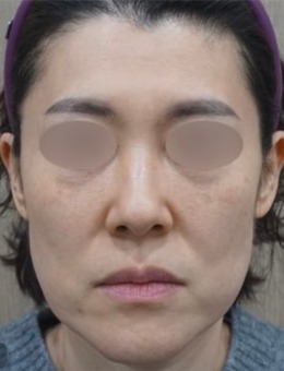 韩国genius皮肤科做面部抗衰提升技术好，法令纹填充前后对比变化很明显！