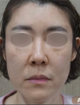 韩国genius皮肤科做面部抗衰提升技术好，法令纹填充前后对比变化很明显！