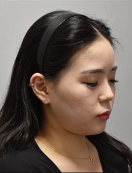 韩国弘大Kate皮肤科做面部紧致提升非常好！他们家也是韩女推荐的皮肤科！_术前