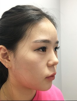 韩国弘大Kate皮肤科做面部紧致提升非常好！他们家也是韩女推荐的皮肤科！_术后