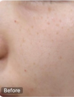 韩国genius皮肤科祛斑真实对比图，Genius皮肤科让素颜也能自带滤镜！