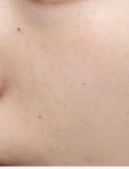 韩国genius皮肤科祛斑真实对比图，Genius皮肤科让素颜也能自带滤镜！