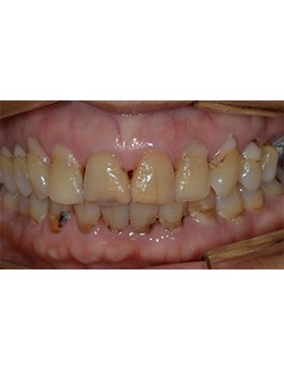 韓國(guó)NewYorkWhite牙科瓷貼面：從“斑駁牙”到“透亮笑”的逆襲