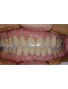 韓國(guó)NewYorkWhite牙科瓷貼面：從“斑駁牙”到“透亮笑”的逆襲