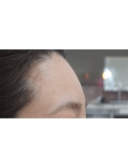 親身經(jīng)歷！韓國genius皮膚科額頭填充，附對比圖分享真實(shí)感受