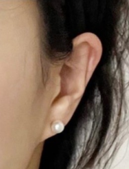 釜山Genius皮膚科耳朵填充實(shí)錄：微調(diào)后耳型與臉型的適配度居然這么自然！