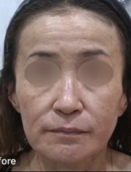 釜山genius皮膚科面部提升對(duì)比:堪稱(chēng)釜山西面的逆齡魔法,Genius皮膚科抗衰病例的進(jìn)階美學(xué)