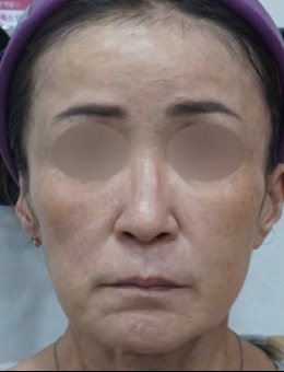 釜山genius皮膚科面部提升對(duì)比:堪稱(chēng)釜山西面的逆齡魔法,Genius皮膚科抗衰病例的進(jìn)階美學(xué)