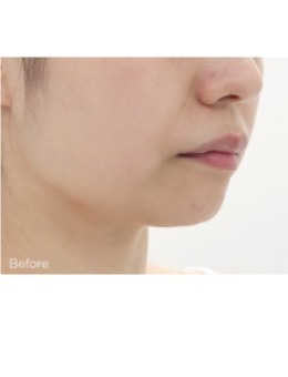 韩国Theia皮肤科对比病例：前后对比明显是韩国排名靠前的优选皮肤科！