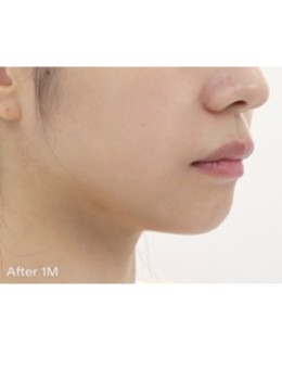 韩国Theia皮肤科对比病例：前后对比明显是韩国排名靠前的优选皮肤科！