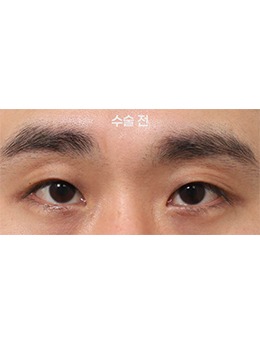 韓國新整形外科眼型調(diào)整術(shù)例展示:7天見雛形的精致改變!