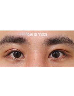 韓國新整形外科眼型調(diào)整術(shù)例展示:7天見雛形的精致改變!