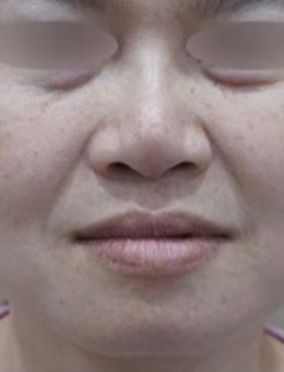 釜山genius皮肤科法令纹填充实例：从显老到自然减龄的蜕变！