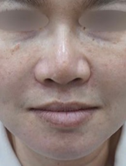 釜山genius皮肤科法令纹填充实例：从显老到自然减龄的蜕变！