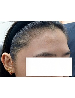 ?韓國GREENY皮膚科｜額頭抗皺聯(lián)合治療:喬雅登+抗皺類針劑的