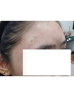 ?韓國GREENY皮膚科｜額頭抗皺聯(lián)合治療:喬雅登+抗皺類針劑的