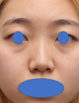 韩国丽尔丽整形外科鼻综合实例对比:从“扁平钝感”到“原生精致”,0.1mm级的精细处理