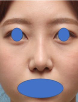 韩国丽尔丽整形外科鼻综合实例对比:从“扁平钝感”到“原生精致”,0.1mm级的精细处理