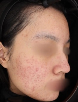 韩国GREENY皮肤科的黄金微针+外泌体Curejet+祛红皮秒，带来的肤质变化