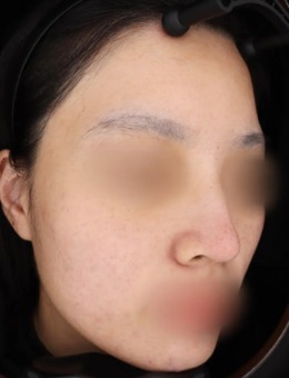 韩国GREENY皮肤科的黄金微针+外泌体Curejet+祛红皮秒，带来的肤质变化