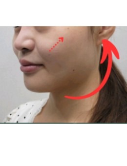 从术例图看Greeny皮肤科提拉对比：轮廓模糊变的越来越清晰！