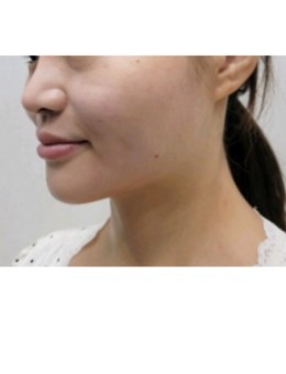 从术例图看Greeny皮肤科提拉对比：轮廓模糊变的越来越清晰！