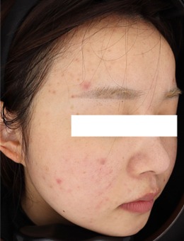 韩国greeny皮肤科祛痘实例分享，采用黄金微针+Juvelook治疗，祛痘很干净！