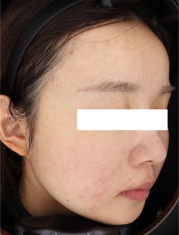 韩国greeny皮肤科祛痘实例分享，采用黄金微针+Juvelook治疗，祛痘很干净！