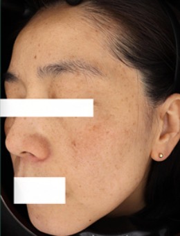 韩国greeny皮肤科祛斑技术真的好！明显对比图大家做参考！