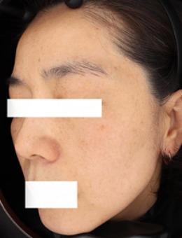 韩国greeny皮肤科祛斑技术真的好！明显对比图大家做参考！