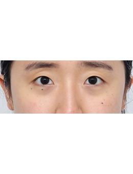 韩国丽尔丽整形外科双眼皮前后对比：闭眼无痕、睁眼有神的妈生感双眼皮实例