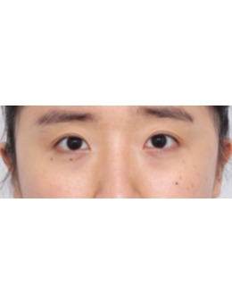 韩国丽尔丽整形外科双眼皮前后对比：闭眼无痕、睁眼有神的妈生感双眼皮实例