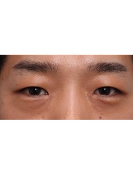 韩国丽尔丽整形外科男士双眼皮术例分享，肿眼泡get自然款双眼皮！