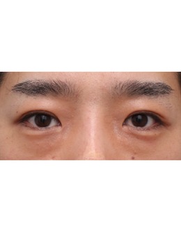 韩国丽尔丽整形外科男士双眼皮术例分享，肿眼泡get自然款双眼皮！