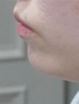 被模糊下颌线拖累美貌？韩国genius皮肤科的下巴调整方案，展现协调线条的塑造细节