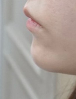 被模糊下颌线拖累美貌？韩国genius皮肤科的下巴调整方案，展现协调线条的塑造细节