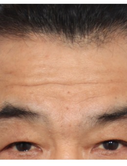 韩国丽尔丽整形外科男性抗衰术例对比纪实!跨越时光的从容