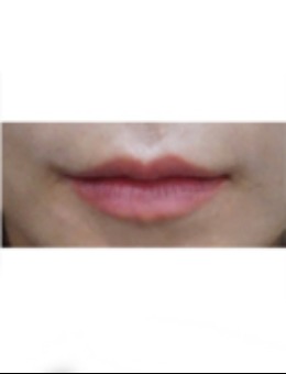 韩国 Genius 皮肤科嘴唇填充实例：自然立体唇形，解锁精致唇部美学