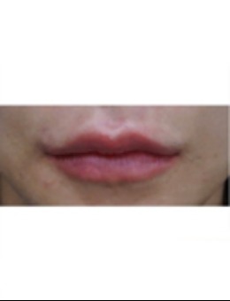 韩国 Genius 皮肤科嘴唇填充实例：自然立体唇形，解锁精致唇部美学