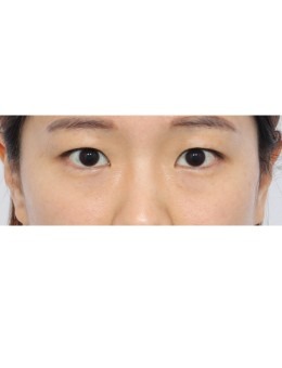 韩国丽尔丽眼部整形术例大揭秘！对比之下见真章与出色技术