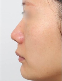 韩国新整形外科的7天蜕变!定制化鼻综合+下巴调整带来侧颜重生!