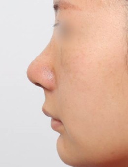 韩国新整形外科的7天蜕变!定制化鼻综合+下巴调整带来侧颜重生!