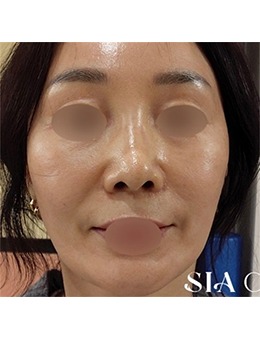 韩国SIA皮肤科面部提升｜垮脸直接“提”上去，这对比我看傻了