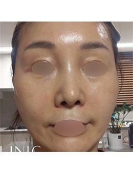 韩国SIA皮肤科面部提升｜垮脸直接“提”上去，这对比我看傻了