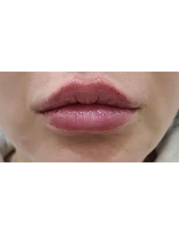 韩国SIA皮肤科丰唇前后对比图|饱满又水润真的爱了~告别干瘪薄唇！