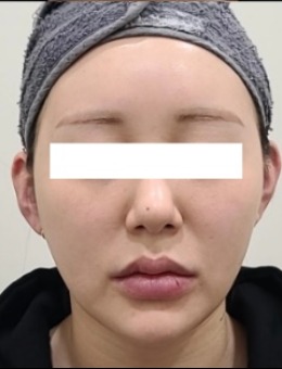 韩国SIA皮肤科面部抗衰前后对比!科学诊断+个性化方案|诠释了自然变漂亮美学理念_术后